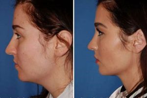 Find Top Nose Job in Portland, OR | Rhinoplasty Guide Safem Fabrication - Precision Engineering & Custom Manufacturing Solutions Find Top Nose Job in Portland, OR | Rhinoplasty Guide | Safem Fabrication - Precision Engineering & Custom Manufacturing Solutions