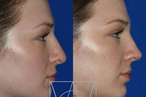 Best Nose Jobs: Portland Oregon Experts & Costs Safem Fabrication - Precision Engineering & Custom Manufacturing Solutions Best Nose Jobs: Portland Oregon Experts & Costs | Safem Fabrication - Precision Engineering & Custom Manufacturing Solutions