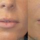 Best Lip Augmentation Portland, OR: Enhance Your Lips | Living in Oregon: Moving Tips, Cost of Living & Best Cities