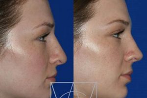 Best Nose Jobs: Portland Oregon Experts & Costs | Living in Oregon: Moving Tips, Cost of Living & Best Cities