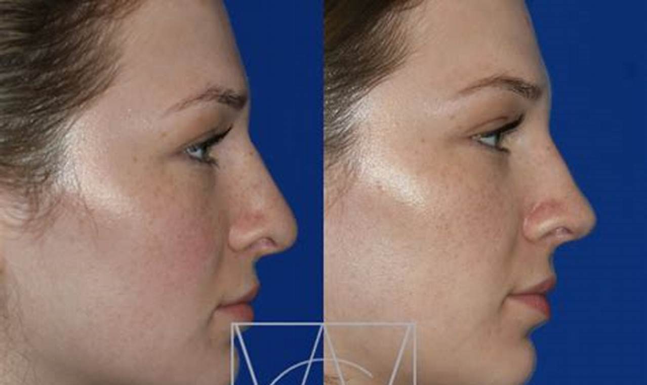 Best Nose Jobs: Portland Oregon Experts & Costs | Living in Oregon: Moving Tips, Cost of Living & Best Cities