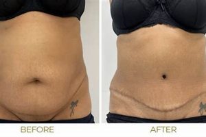 Premier Tummy Tuck in Portland, OR: Transform Your Body! | Living in Oregon: Moving Tips, Cost of Living & Best Cities