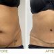 Premier Tummy Tuck in Portland, OR: Transform Your Body! | Living in Oregon: Moving Tips, Cost of Living & Best Cities