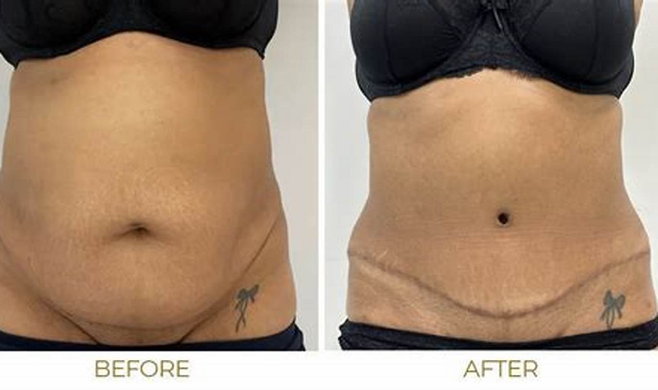 Premier Tummy Tuck in Portland, OR: Transform Your Body! | Living in Oregon: Moving Tips, Cost of Living & Best Cities